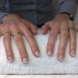 direct na behandeling ex-nagelbijter jane